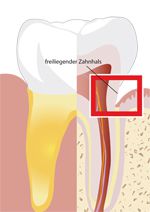 Abb. Zahn mit freiliegendem Zahnhals