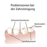 Problemzonen bei der Zahnreinigung Problemzonen bei der Zahnreinigung
